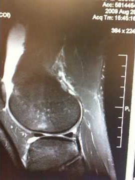 MRI Right Knee Torn ACL
