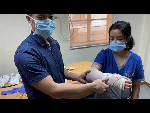 Coaptation Splint or U-Mold for forearm and wrist fractures