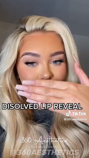 Dissolved Lips Transformation Revealed by 360 Aesthetics