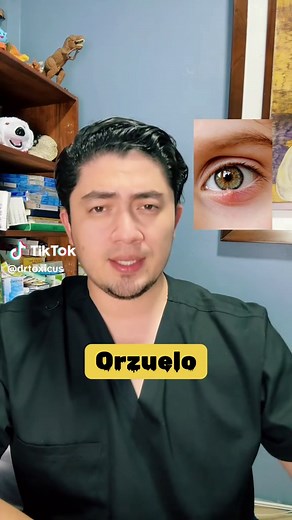 Cómo tratar tu Orzuelo en casa de manera efectiva