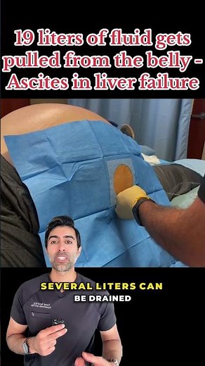 This Procedure Removes Liters of Fluid from the Abdomen