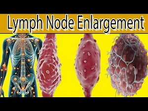Lymph Node Enlargement - 7 Most common causes