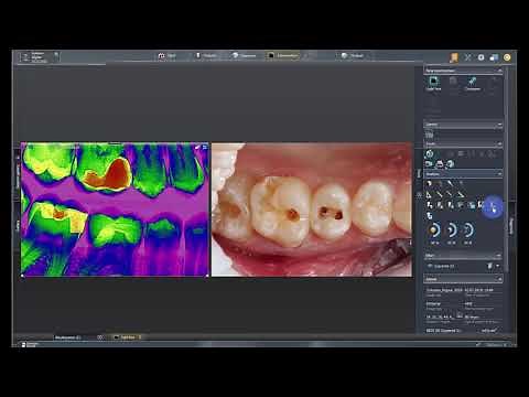Sidexis 4 V 4.3 Tutorial: Flip Filter