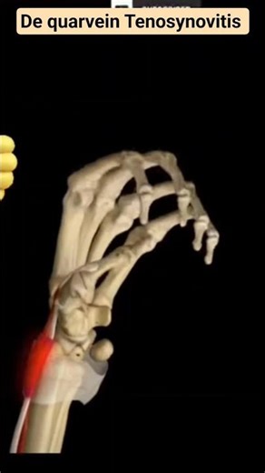De Quervain's tenosynovitis 3d Animation#Wrist pain #Tenosynovitis Symptoms