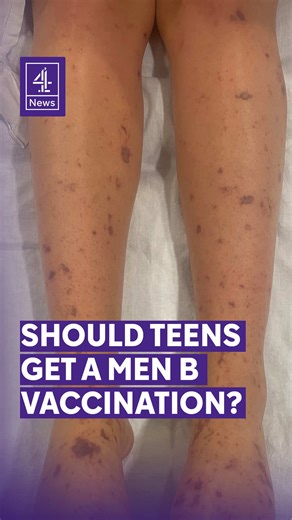 Meningitis B is the strain behind the outbreak in Kent and if you’re over the age of 11, chances are you haven’t been vaccinated against it. That’s because in the UK the vaccine has only been offered to babies since 2015. Adolescents are also at risk of getting ill from MenB so should they be offered a jab? #Meningitis #MeningitisB #Kent #Vaccination #C4News