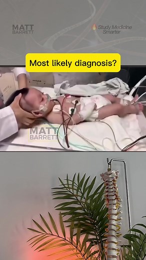 Learn about Brudzinski Contralateral Reflex Sign in Medicine