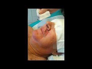 BEFORE & AFTER - "BCC excision from the upper lip with skin flap repair". #37