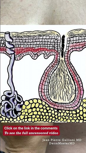 What causes an epidermal inclusion cyst? #cystpopping #dermatology #cyst #DermMasterMD
