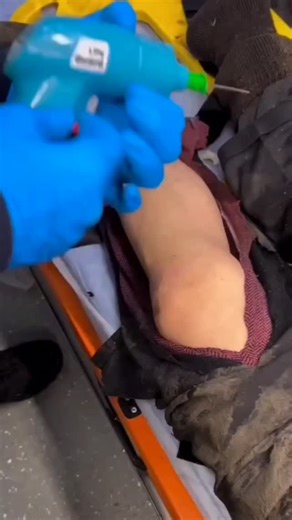 Uni Medical care on Instagram: "Intraosseous access (IO) is used in emergency situations when peripheral or central venous access is difficult or impossible to obtain, especially in critically ill patients who require rapid administration of medications, fluids, or blood collection. Some common cases include: Indications: 1. Cardiopulmonary arrest (CPA): When venous access cannot be established within 90 seconds, IO is a quick and effective route. 2. Hypovolemic or septic shock: In cases of seve