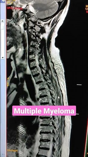 Multiple Myeloma Spine MRI #viral #mri #youtubeshorts