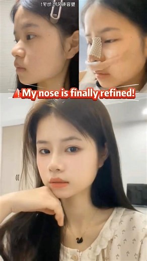 Help every friend who is troubled by nose problems, please contact at the home page.#rhinoplasty