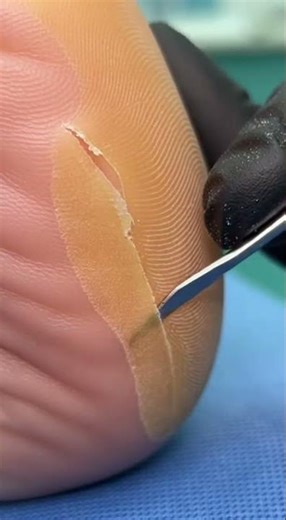 The Most Satisfying Heel Scraping Ever Callus Removal ASMR #asmr #satisfying #podiatry #peliculas