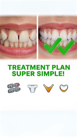 Gap Between Teeth? Dentist Explains #dentalcare #dentalfacts