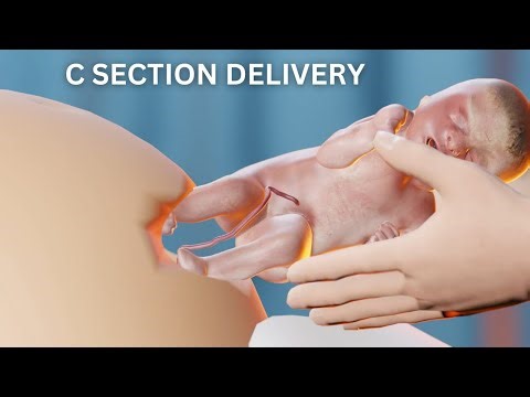 Cesarean Delivery 3D Animation | C Section Delivery #babydelivery