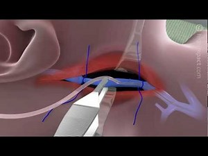 Proper Technique for Internal Jugular Cannulation