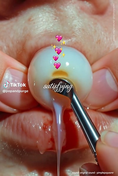Oddly Satisfying ASMR style video of a pimple being removed from the lips. #pimple #pimplepopper #asmrvideo #satisfyingvideo #lips