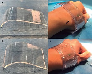 TR Band modification for distal transradial access hemostasis