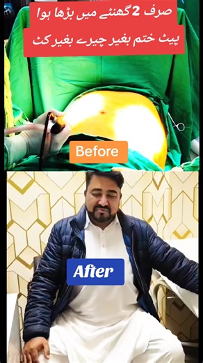 Get a Flat Stomach in Two Hours with Liposuction