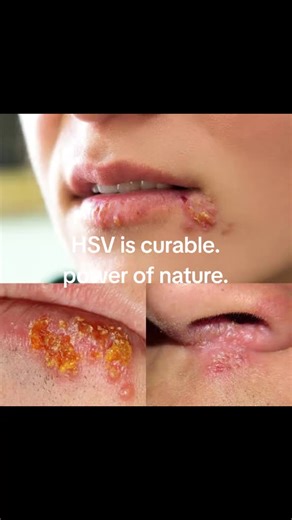 HSV1 HSV2 HPV #herpes #herpesgeneral #herpessimplexvirus #herpessimplex #stdawareness #coldsores #usa #usa_tiktok #usarmy #herbs #herb #herbalremedies #herbalmedicine #herbalife #herbalist #natural #remedy #usanews #usapolitics #usaentertainment #hospital #hospitallife #hospicenurse #hospitalfood #hospitalbed #hsv #hsv1 #cure #curecancer #cureherpes #herpescureinusa #herpescure2024 #cancerawareness #cancersurvivor #lupus #shingles #shinglesvirus #shinglesawareness #herpeszoster #herpes #usacolle
