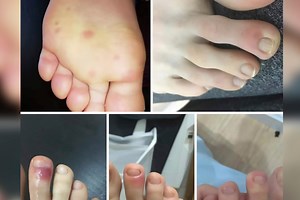 Covid toe: What is this new Coronavirus symptom that turns toes, fingertips purple?