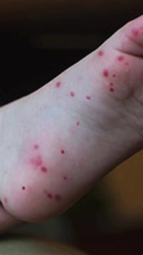 Have you heard of Hand, Foot, and Mouth disease? It's going around local schools, and this week's Ask an Epi video has everything you need to know to keep your family healthy! | Toledo-Lucas County Health Department