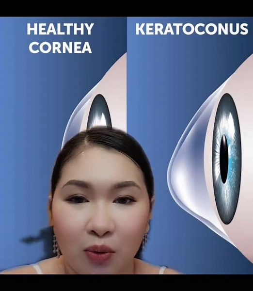 Understanding Astigmatism and Corrective Lenses