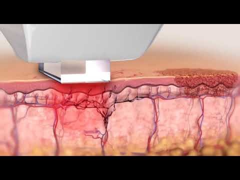 InMode Lumecca IPL (Intense Pulsed Light)