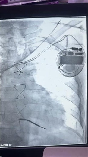 Cardiac Pacemaker Implant | Real Procedure #shorts #heart #medical #viral