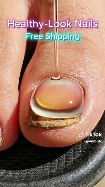 Recurring fungal nails?This portable pen solves it easily #tiktokblackfriday #tiktokshop #tiktok #toenail #nail