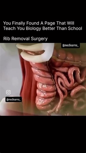 Medical Student on Instagram: "Rib removal surgery (in females)—often called rib resection or “waist slimming rib surgery”—is a procedure where a surgeon removes part (or all) of one or more ribs, most commonly the lower ribs (11th and 12th “floating ribs”), to create a smaller waistline or change torso shape What ribs are removed? Usually: • 11th and 12th ribs (floating ribs), because they aren’t attached to the sternum in front and are easier/safer to remove than upper ribs. How it’s done (typ