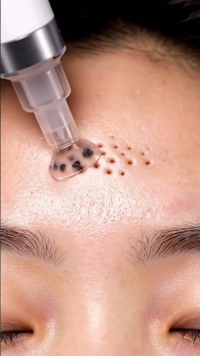 Forehead Blackhead Vacuum Extraction | Satisfying Sebum Removal