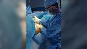 BodyTite of Mons Area with a Labiaplasty!