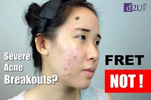 Fast Acting Acne Solution Clear Your Skin in Just 10 Days! *Groundbreaking treatment for moderate to severe acne vulgaris *Reduces redness and irritation to visibly improve complexion *Fades dark spots and corrects uneven skin tone *Prevents future breakouts with continued use | D2U