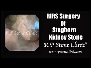 RIRS Surgery of Staghorn Kidney Stone