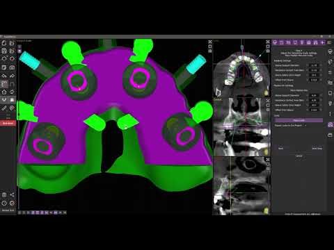 Stackable Surgical Guide (case with bone reduction and immediate loading)