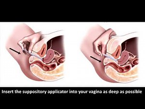 How to use suppository by applicator