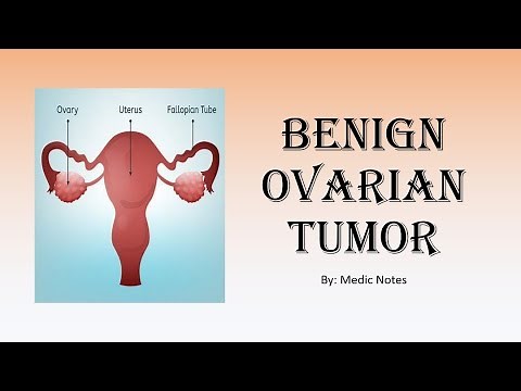 [O&G] Benign ovarian tumor - classification, clinical features, investigation, treatment