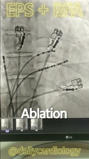 EPS RFA PROCEDURE | TREATMENT #shorts #cardiology