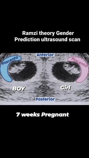 1.5M views · 2K reactions | 7 weeks gender reveal ultrasound Scan | Dr.aneela manzoor-RPH | Facebook