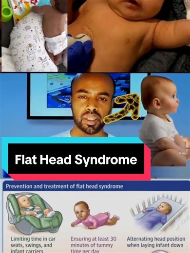 Understanding Flat Head Syndrome in Infants