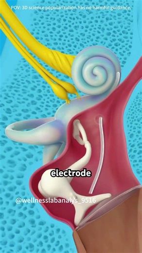 Cochlear implant surgery procedure medical animation 3D #3danimation #doctor #doctor