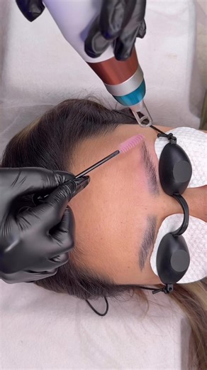 Laser removal #lasertattooremoval #tattoo #eyebrowtattoos #powderbrows