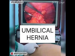 Umbilical Hernia treatment with Composite Mesh | IPOM PLUS