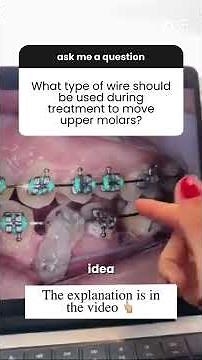 Molar Mesialization: The Step-by-Step You Need to Know!