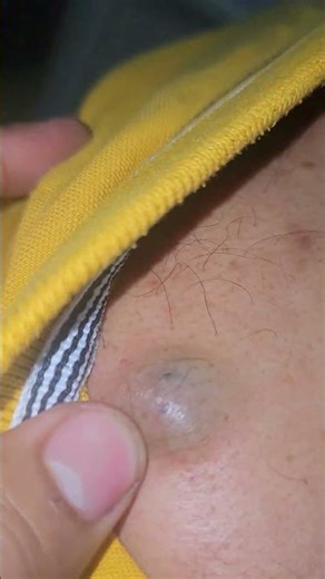 Sebaceous Cyst Swelling #imwell #medicaldoctor #spotdiagnosis #integrativemedicine