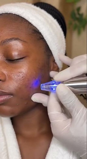 Viral Blackhead Vacuum ASMR – Most Satisfying Pop Ever!