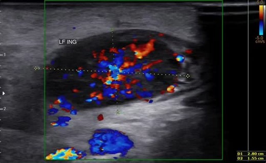 Radiology @all abnormalities 🥏🥏 on Instagram: "Ultrasound Report – Left Inguinal Region Clinical Presentation The patient presents with gradually progressive left inguinal swelling and tenderness for the past 1.5 weeks. Patient Details Age: 11 years Gender: Male Ultrasound Findings An enlarged left inguinal lymph node measuring 2.8 × 1.5 cm is identified. The lymph node shows loss of the normal fatty hilum. Increased internal vascularity is noted on color Doppler imaging. Surrounding subcutane