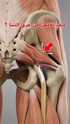 NsKinesi👩‍⚕️🩺 | ‎✅️💯واش كتحسّ بألم فالأرداف وكيهبط حتى للساق؟ 🤕 يمكن ماشي Sciatique حقيقية… يمكن يكون Syndrome du piriforme (muscle pyramidal). 📌 الفرق...‎ | Instagram