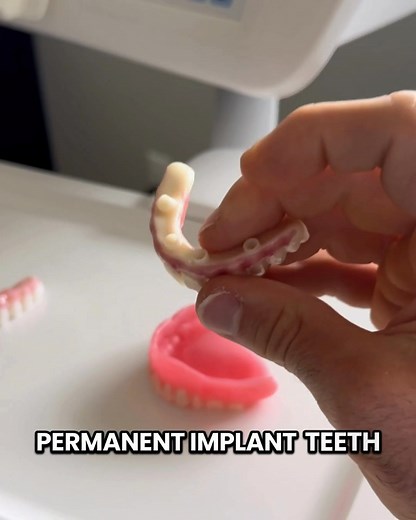 16 reactions | Get a permanent smile!  Castro Valley Dental - All-On-4 full mouth implants can help you say goodbye to cavities, broken teeth, a damaged smile & denture glue. A new smile & teeth you can get in just 1 DAY. Book your consult with Dr. Yuen today and enjoy a beautiful smile, full bite strength, and pain free! | Castro Valley Advantage Dental | Facebook