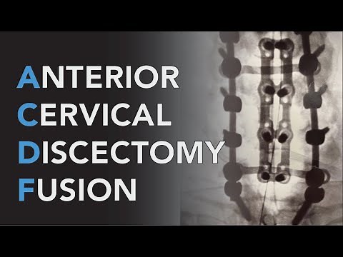 Fused Episode 5: Anterior Cervical Discectomy and Fusion Surgery (ACDF)